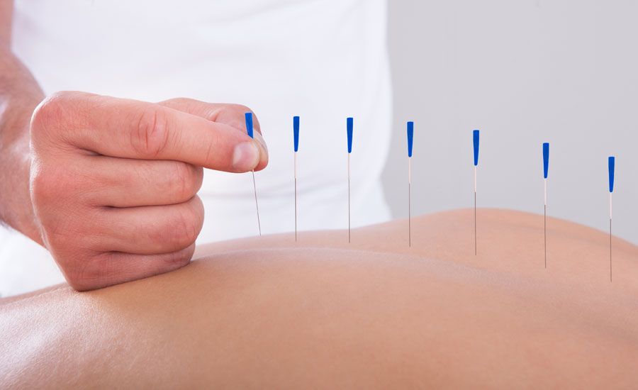 An acupuncture practitioner inserts needles into a patient's back